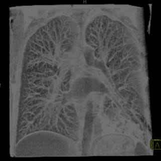 肺・気管支血管造影
