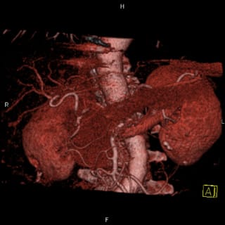 膵臓の血管造影3D画像